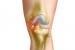 Как лечить артрит коленного сустава